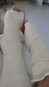 Broken wrist and foot